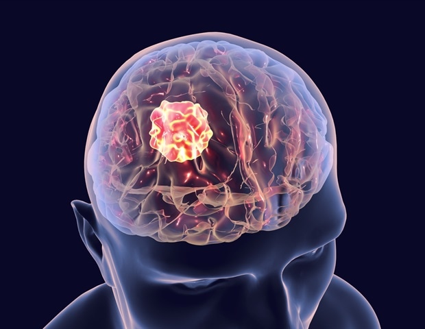 Advancements in AI Technology for Early Detection of Glioblastoma Progression