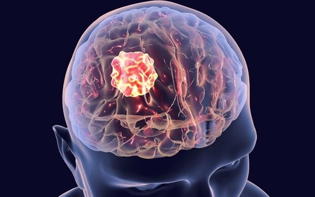 Advancements in AI Technology for Early Detection of Glioblastoma Progression